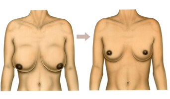 correction ptose mammaire