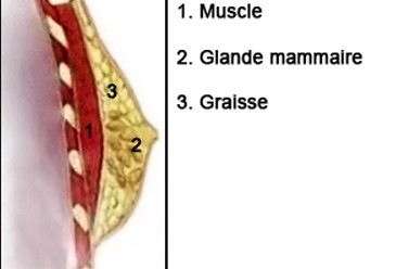 hypertrophie mammaire