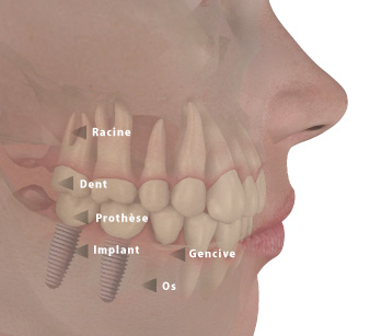 les composants d'implant dentaire