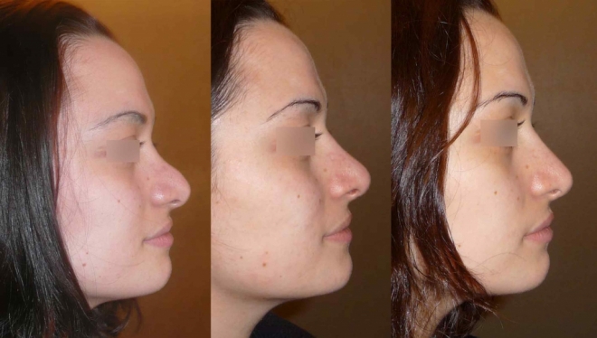 rhinoplastie secondaire tunisie