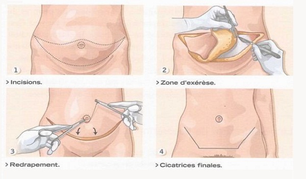 techniques abdominoplastie tunisie